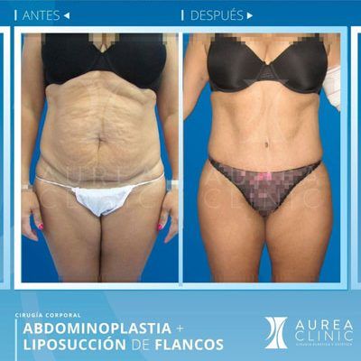 abdominoplasty
