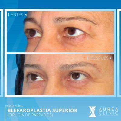 blepharoplasty-seville