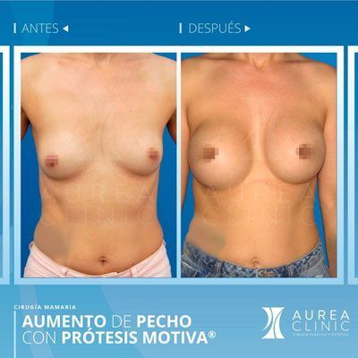 breast-augmentation