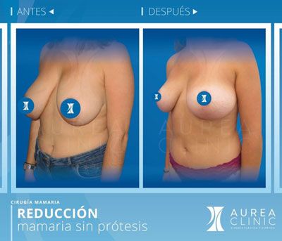 breast-reduction breast-reduction