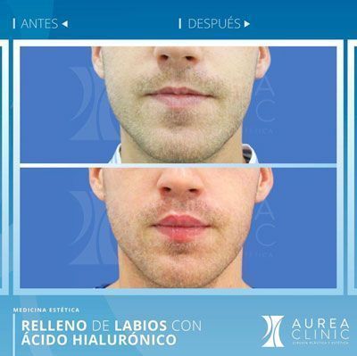 fillers-with-hyaluronic-acid-seville