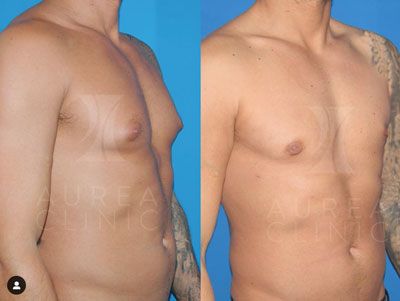 gynecomastia-breast-removal-in-men