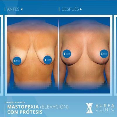 mastopexy-or-breast-lift