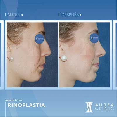 rhinoplasty rhinoplasty