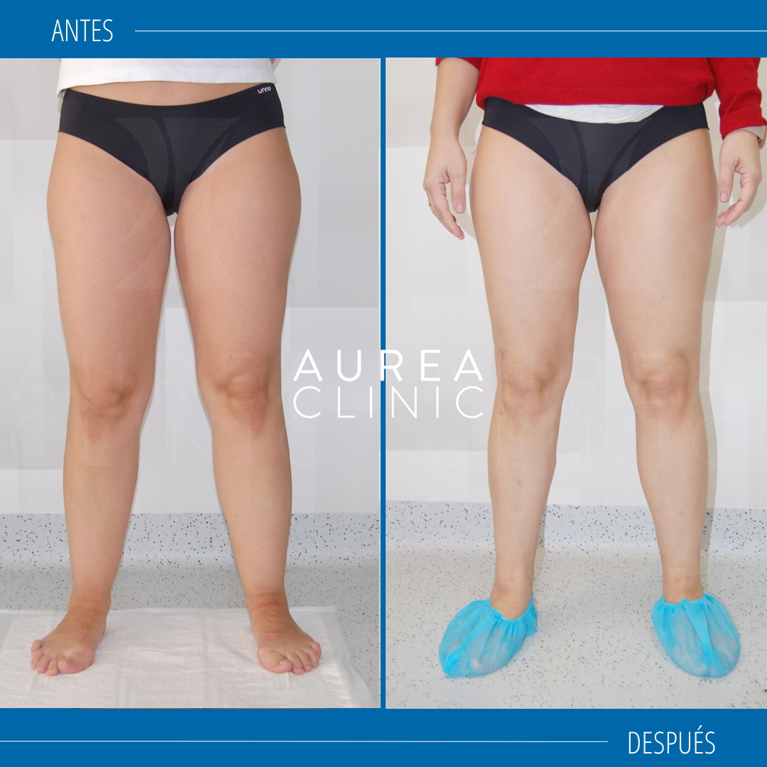 lipedema treatment