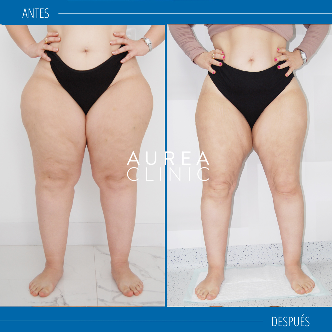 lipoedema treatment before after