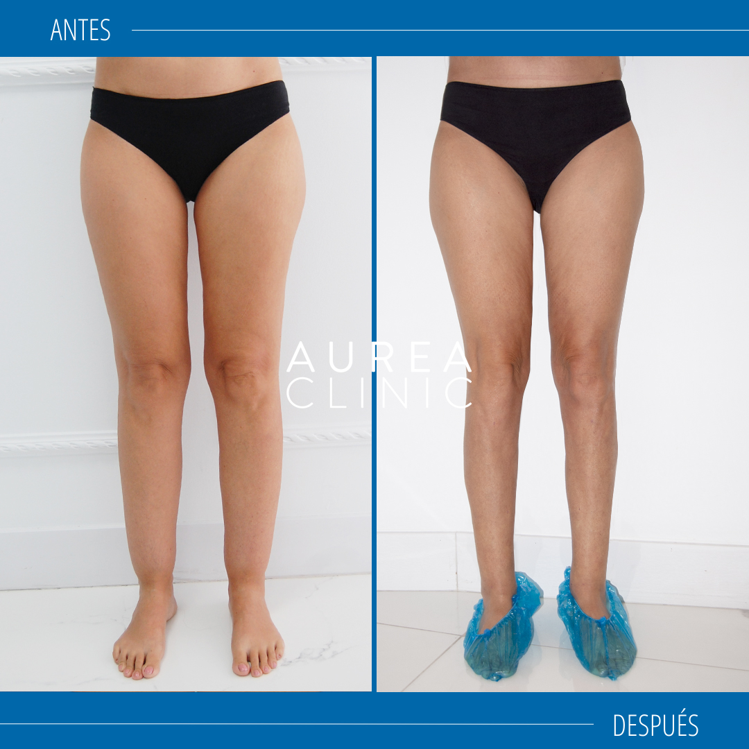 lipoedema treatment before after