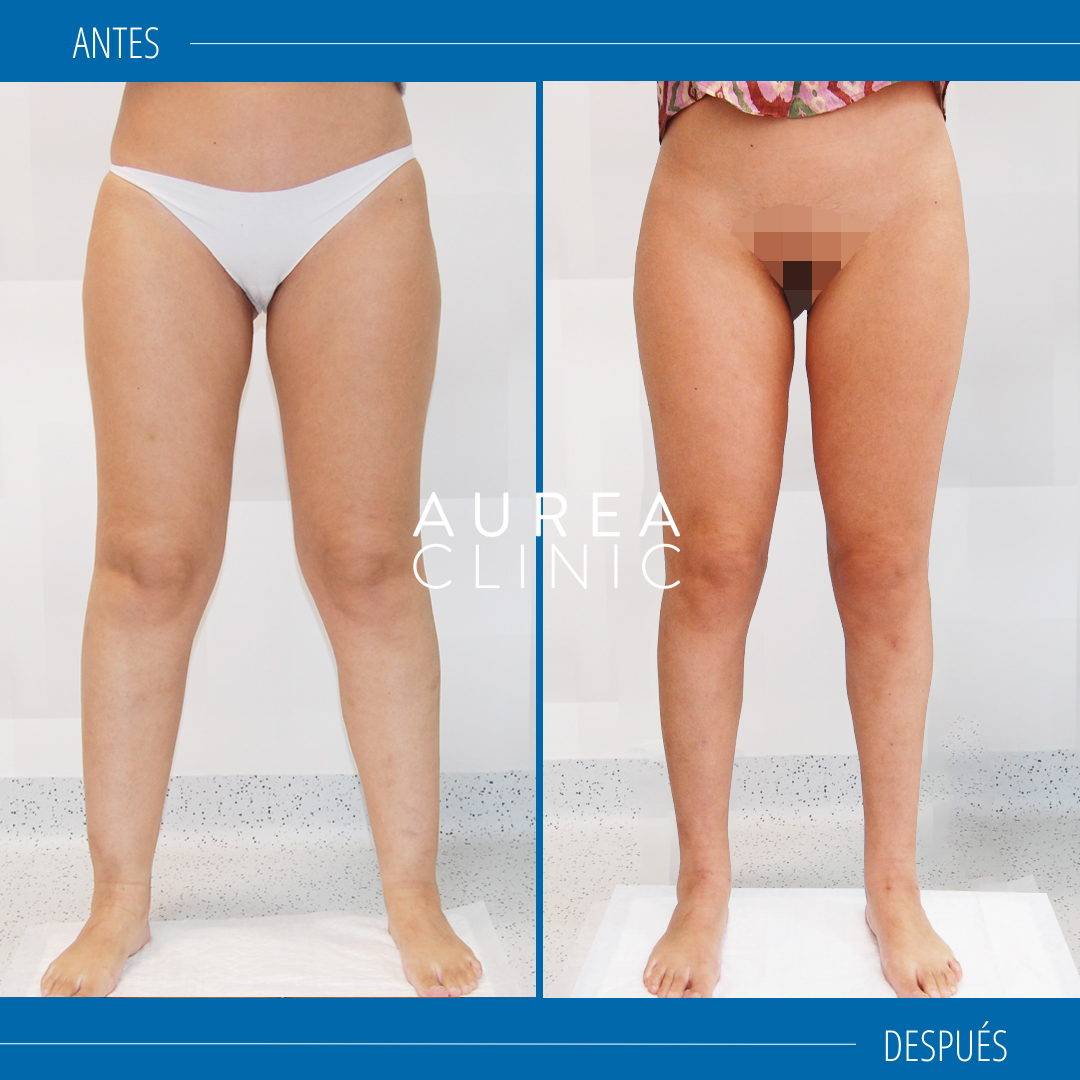 lipedema treatment before and after