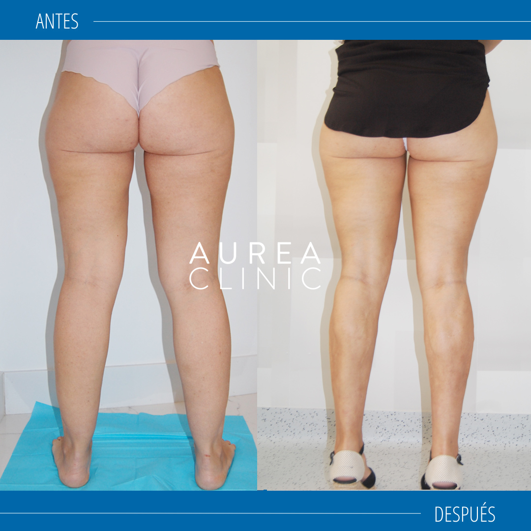 lipedema treatment before and after
