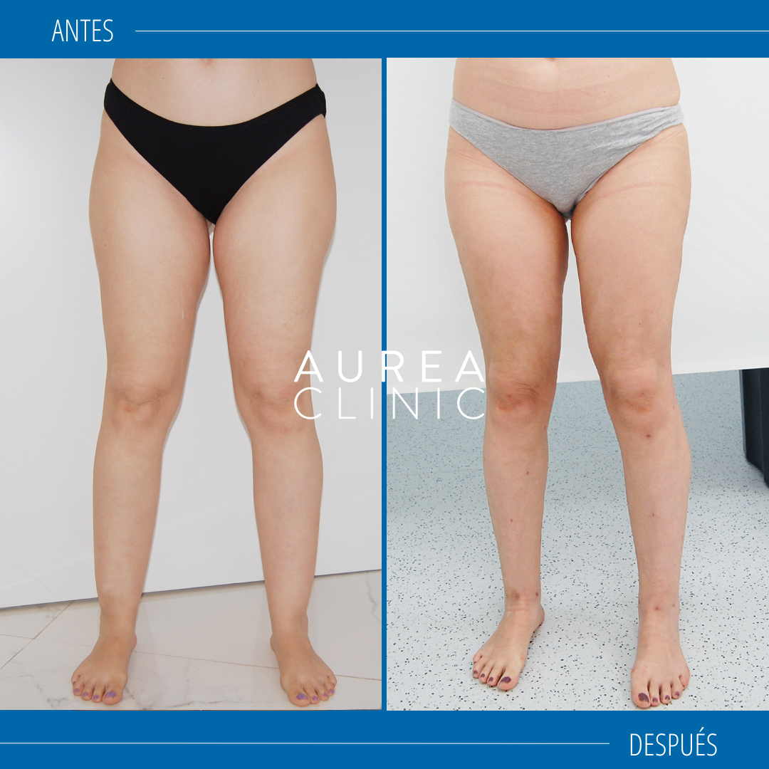 lipedema results