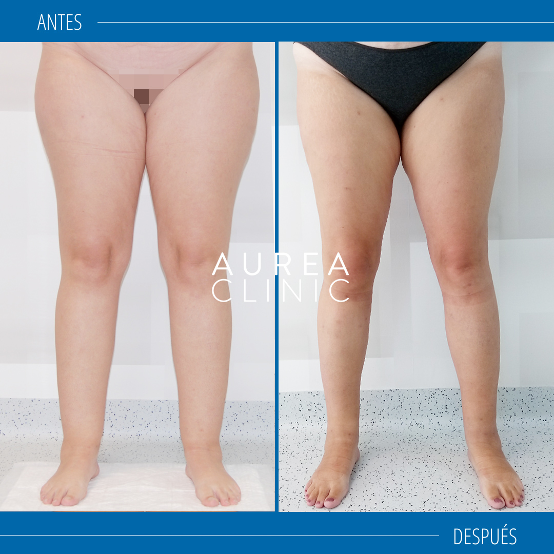 lipoedema before after