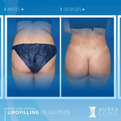 lipofilling