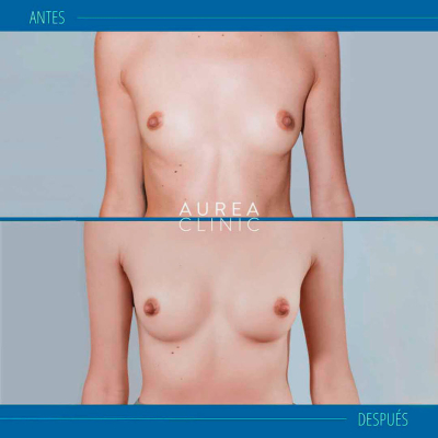 Mia Femtech before after